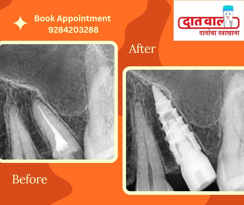 Dental Implants